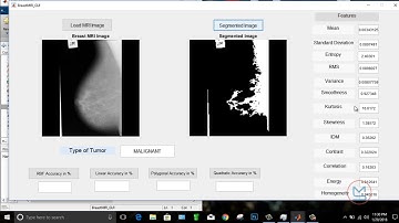 Breast Cancer Detection Using Machine Learning(Random Forest and ELM Classifier.) with MATLAB