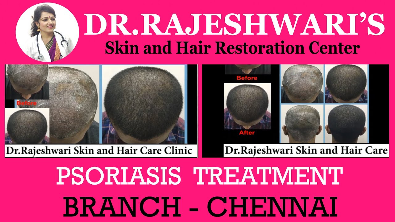 Best 100 Solution Psoriasis Treatment Dr.Rajeshwari Skin and Hair
