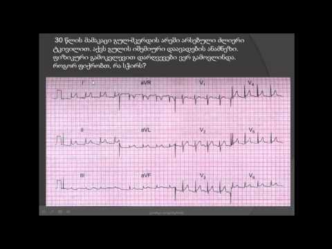 ეკგ / ვირუსული პერიკარდიტი და პარკუჭების ნაადრევი რეპოლარიზაციის სინდრომი /virusuli perikarditi