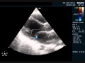 MAYOCARDITES  IN  LEPTOSPIROSIS - ECHOCARDIOGRAPHY