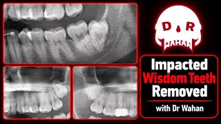 Wisdom Tooth Removal Video- with Dr Wahan