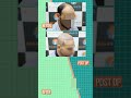Grade-6 to Natural Hairline | 4,380 Grafts in 8 Months | Alloroots