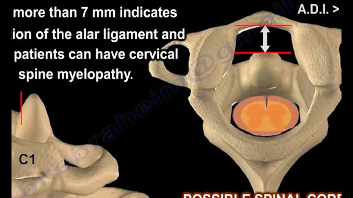 Rheumatoid Arthritis of the cervical spine - Everything You Need To Know - Dr. Nabil Ebraheim