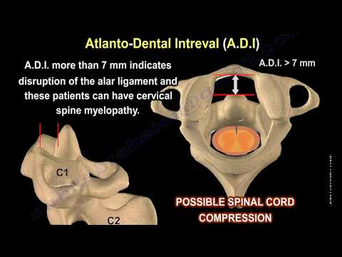 Rheumatoid Arthritis of the cervical spine - Everything You Need To Know - Dr. Nabil Ebraheim