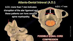 Spine Concepts, Cervical Rheumatoid Arthritis - Everything You Need To Know - Dr. Nabil Ebraheim