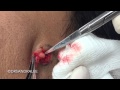 Cyst Excision And A Shave Removal On A Young Man S Face For Medical Education NSFE Cyst Excision And A Shave Removal On A Young Man S Face For Medical Education NSFE