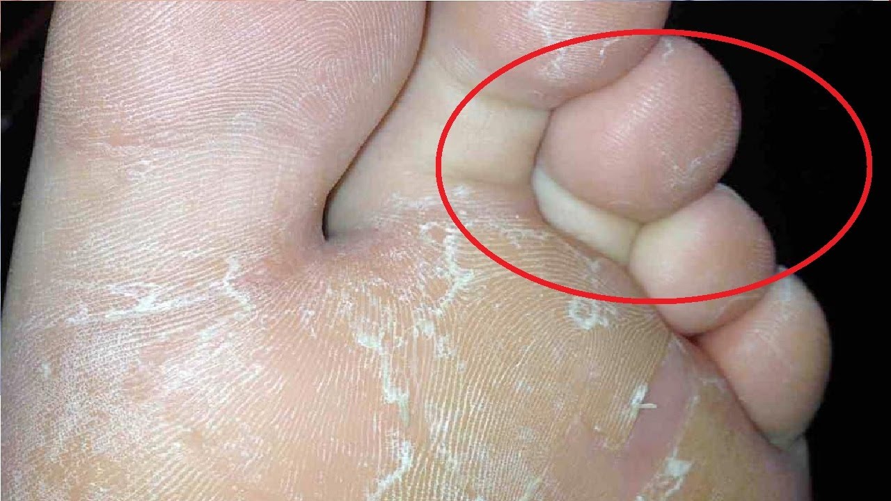 how to get rid of athlete's foot home remedies YouTube