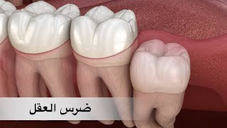 رائحة الفم الكريهة ومشاكل ضرس العقل