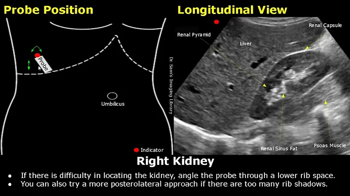 Kidney Ultrasound Probe Positioning | Transducer Placement & Scanning | Abdominal USG | Sonography - DayDayNews