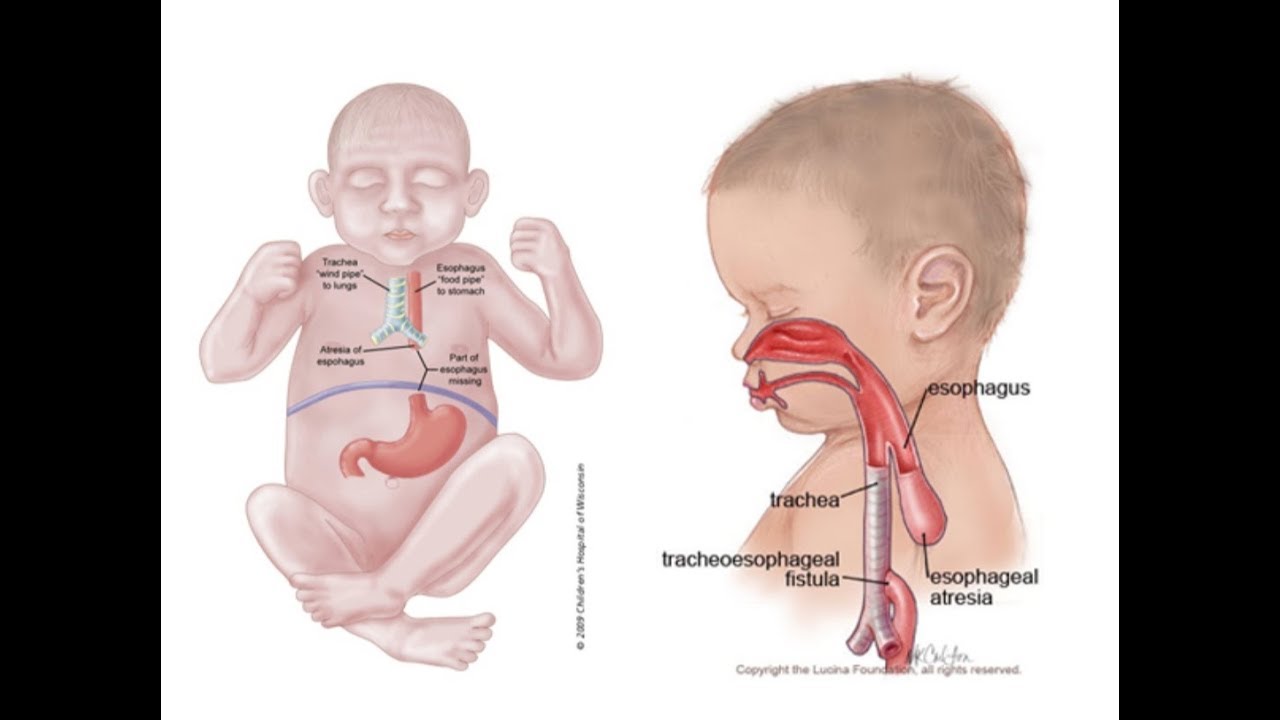 Отсутствие пищевода. Пищевод новорожденного. Анатомия пищевода у детей. Пищеварительная система новорожденного.