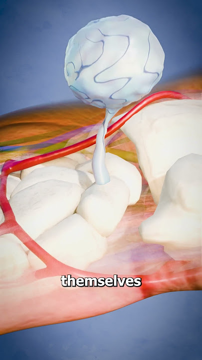 Removing Ganglion Cysts 😨