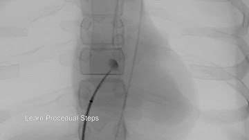 Transseptal Puncture