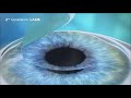 Фемто ЛАСИК (FemtoLASIK) и СМАЙЛ (ReLEx SMILE) - сравнение методов лазерной коррекции зрения