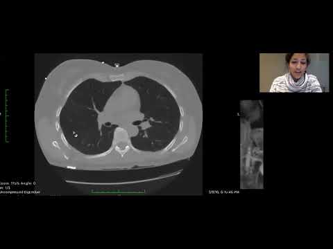 Catamenial pneumothorax: review of peritoneal flow - Dr. Aarti Sekhar