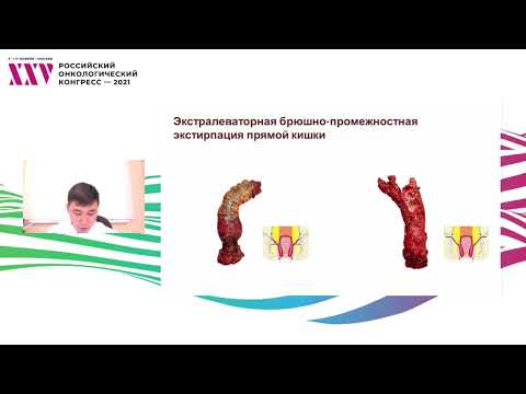 Выбор варианта брюшно-промежностной экстирпации при местнораспространенном раке прямой кишки