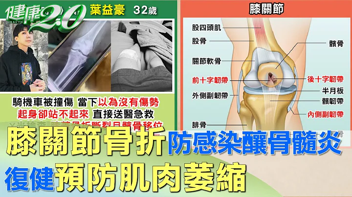 "膝关节骨折"防骨头感染酿骨髓炎 复健防"肌肉萎缩" 健康2.0 - 天天要闻