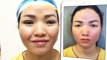 Tạo Mắt 2 Mí Rõ Dàng Sau 30 Phút Cắt Mí Mắt Mani Open Deep 5D.