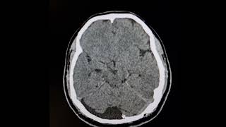 : Arachnoid cyst