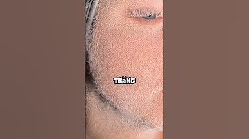 Căn Bệnh Lạ Khiến Lông Mọc Không Ngừng!