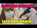 Лазерная эпиляция / Laser hair removal