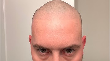 What happens on a Second Session Scalp-Micropigmentation treatment!!