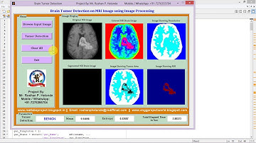 Brain Tumor Detection Using Matlab !! IEEE Based Project
