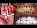 في دقيقتين فقط ،هذه الوصفة المدهشة سوف تضيء الأسنان الصفراء القذرة مثل اللؤلؤ. علاج الأسنان البيضاء