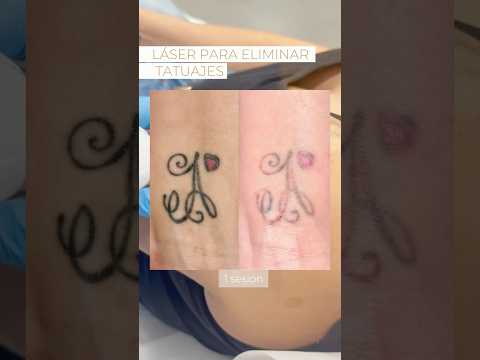 Sí, se puede eliminar un tatuaje… #laser #tattoo