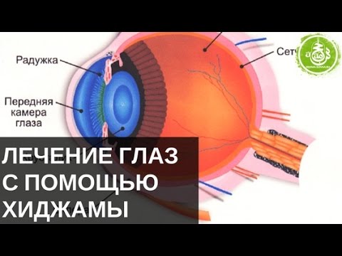 Лечение глаз с помощью Хиджамы | Обучение Хиджаме