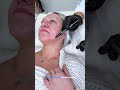 Жевательная мышца (masseter)