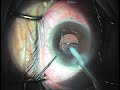 1st phacoemulsification cataract surgery