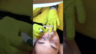 Electrolysis is a method of removing individual hairs from the face or body.