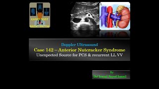 Ultrasound Case 142 - Recurrent Varicose Veins - Anterior Nutcracker Syndrome