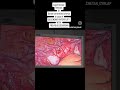 #ventrofixeduterus#secondaryinfertility #surativf laparoscopy release of ventrofixed uterus
