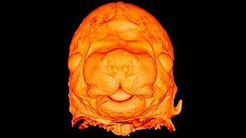 High resolution episcopic microscopy (HREM)