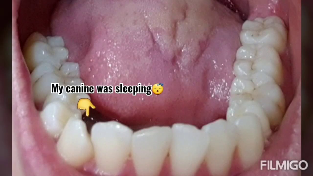 Trending Braces Time Lapse 2020 Crooked teeth Upper&Bottom view