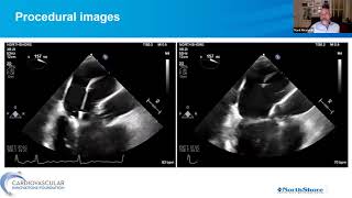 CVI - Transcatheter Mitral Innovations