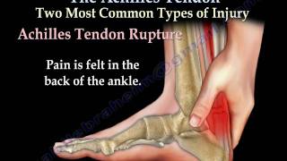 Achilles Tendon rupture ,tear, tendonitis - Everything You Need To Know - Dr. Nabil Ebraheim