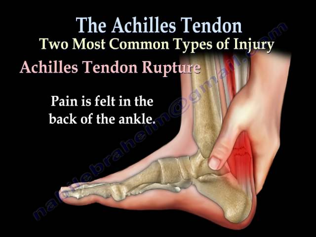 What You Need to Know About Achilles Tendonitis