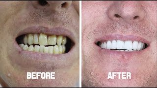 Cosmetic Dentistry (Zirconium Crowns) - Leon from The UK