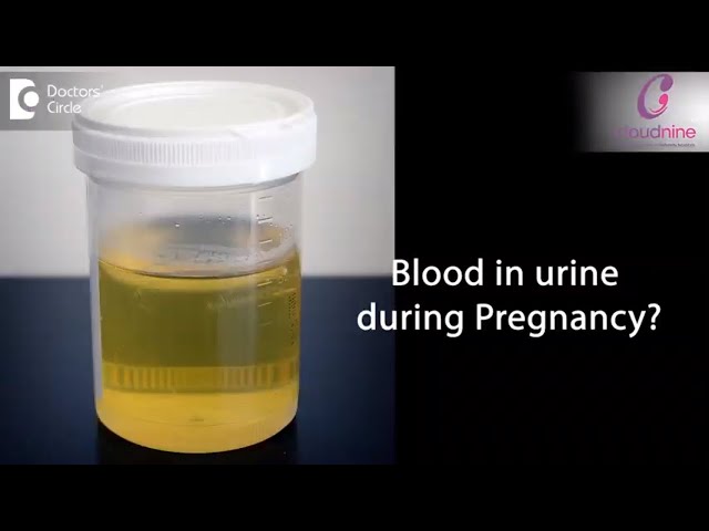 What can cause blood in urine during pregnancy? - Dr. Manjari Kulkarani of  Cloudnine Hospitals 