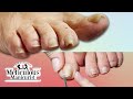 👣Pedicure THICK Pincer Toenail👣