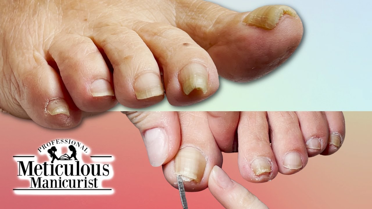 👣Pedicure Tutorial on Pincer Toenails that Cause Pain👣