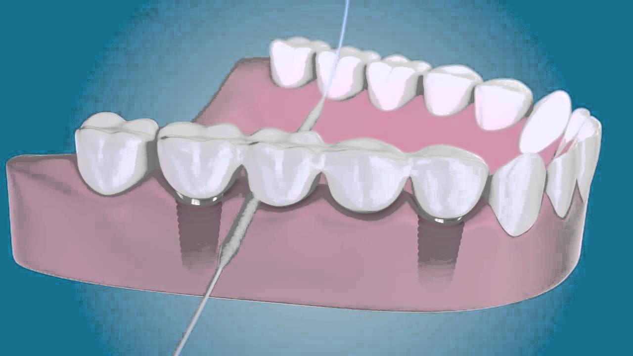 TePe Bridge & Implant Floss zubní nit - YouTube