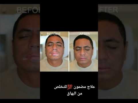 التخلص من البهاق البهاق البرص البياض الجلدي الحل النهائي