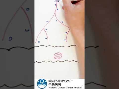 イラストで大腸がんを分かりやすく解説！髙見澤先生イラストシリーズ