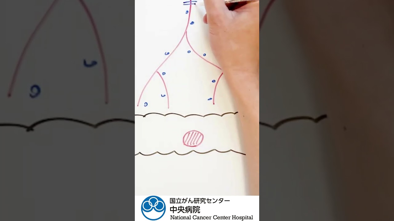 Colon cancer surgery explained in easy-to-understand illustrations