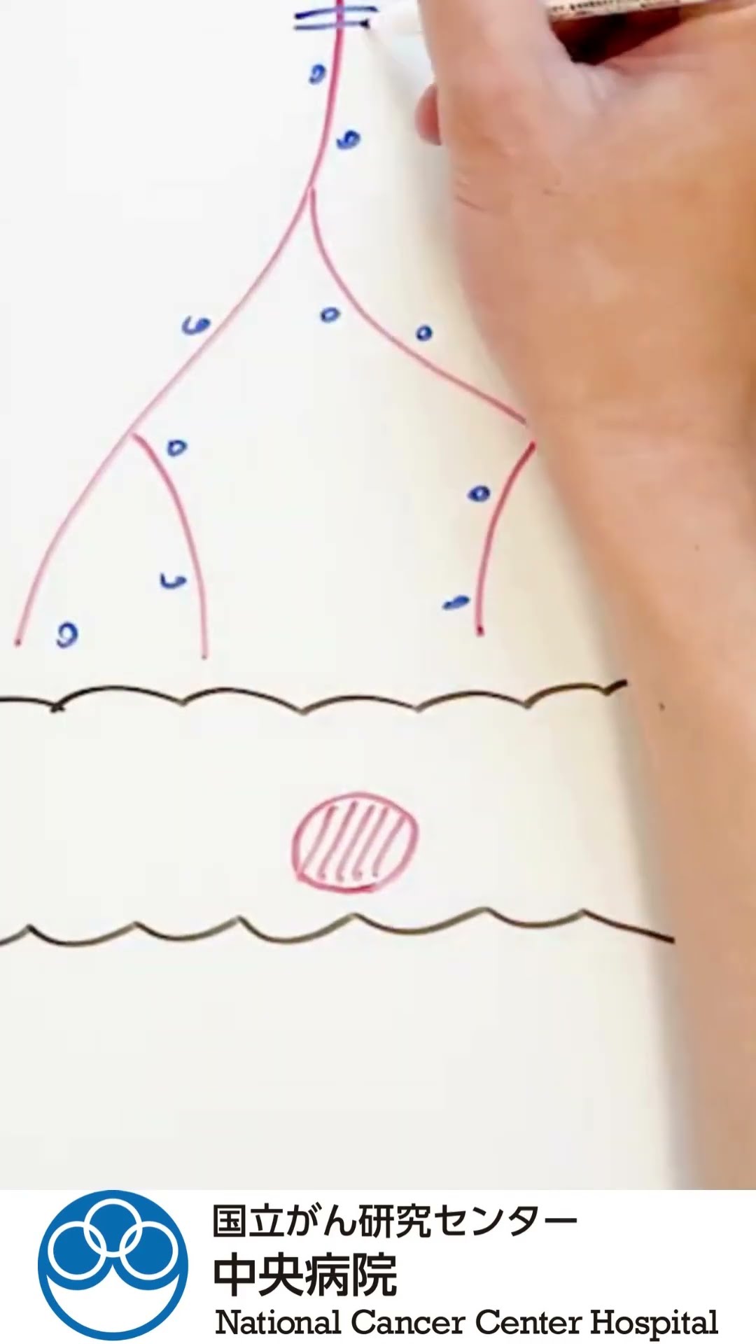 Colon cancer surgery explained in easy-to-understand illustrations