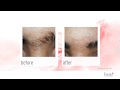 Laser hair removal  frac3