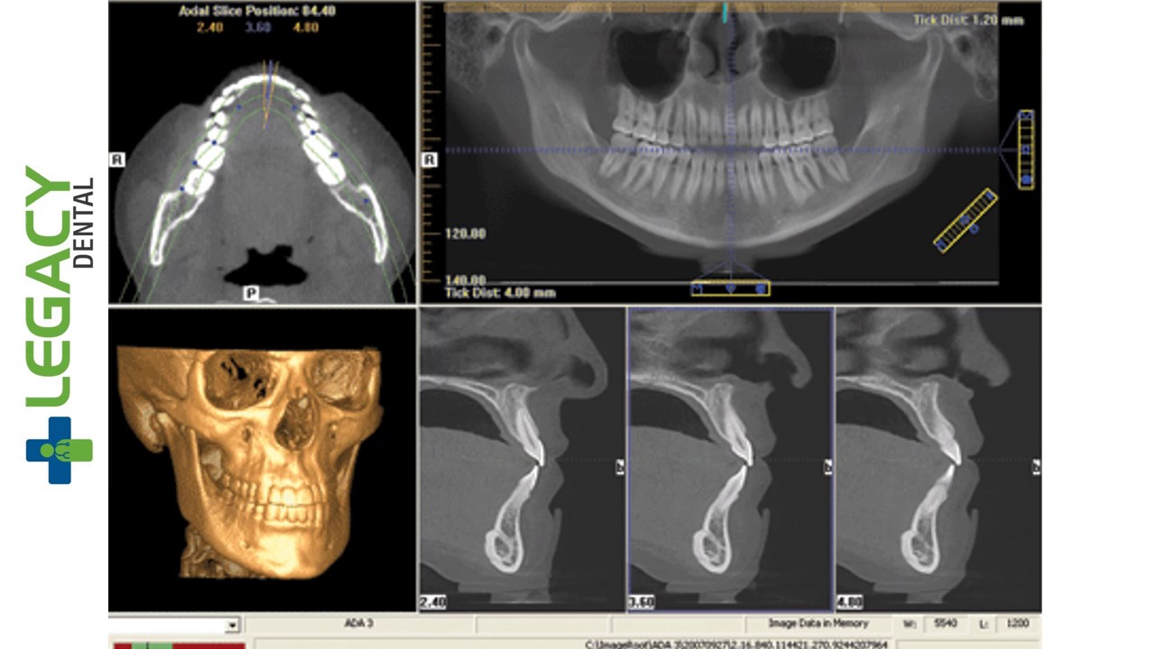 CBCT - AN ADVANCED  3D IMAGING TECHNOLOGY @ LEGACY DENTAL KIGALI